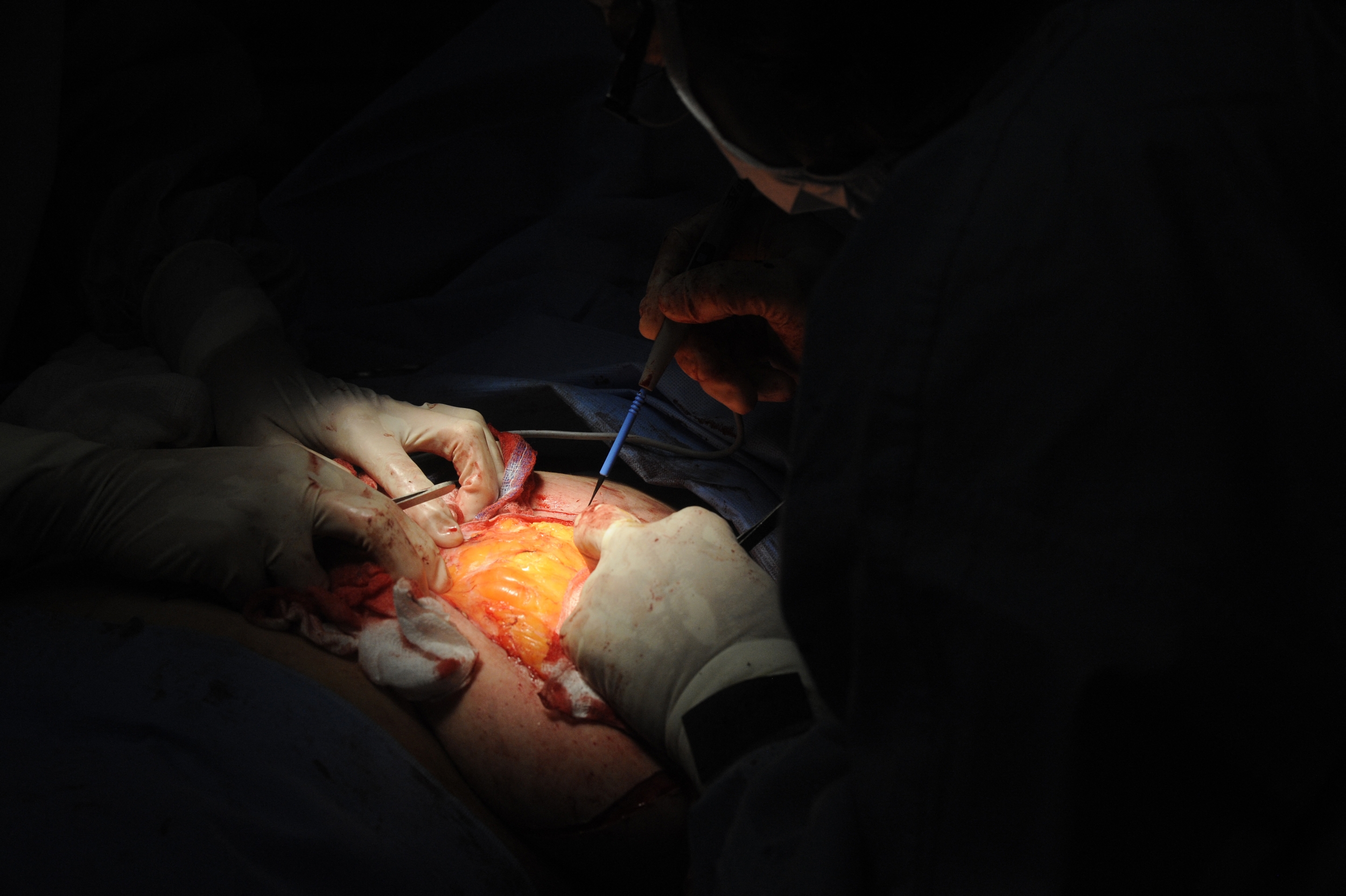 Jury Orders Medtronic to Pay $88 Million After Finding Surgeons Were Not Adequately Warned About a Hernia Mesh