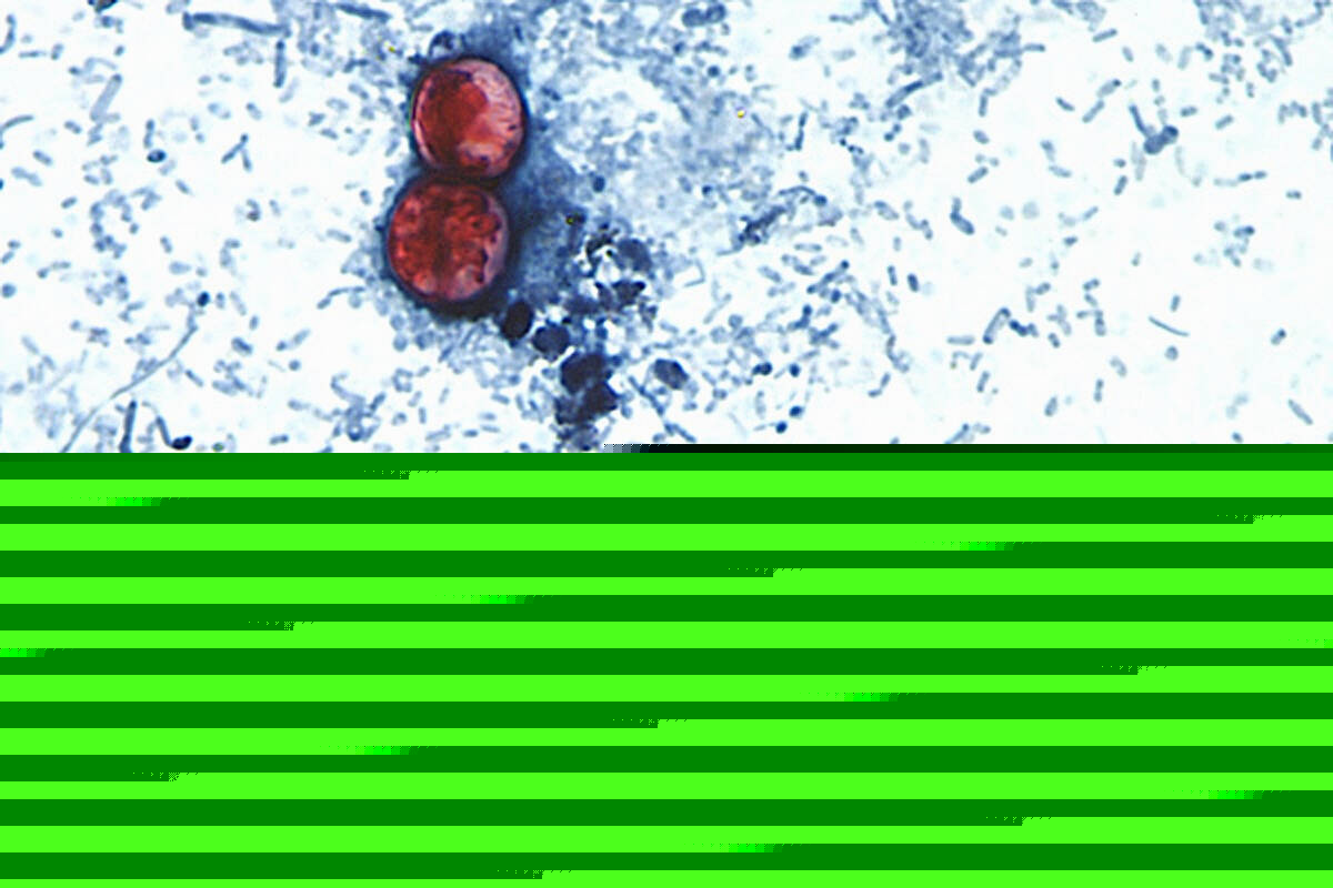 Michigan reports first 2 US deaths in outbreak of cyclospora