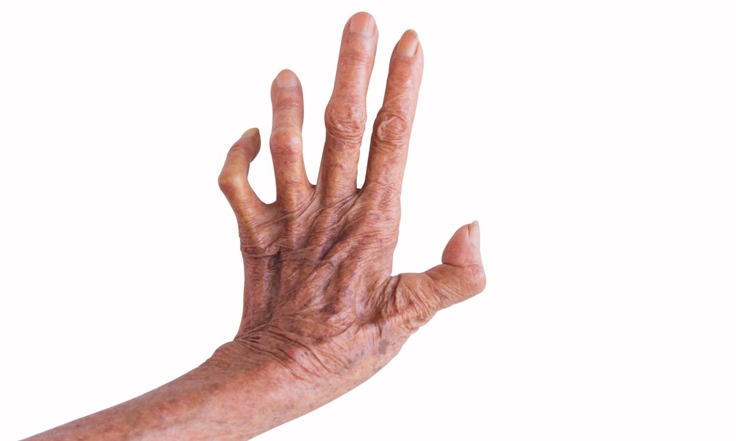 Painful Genital Ulcers May Signal Rare Leprosy Complication, Case Report