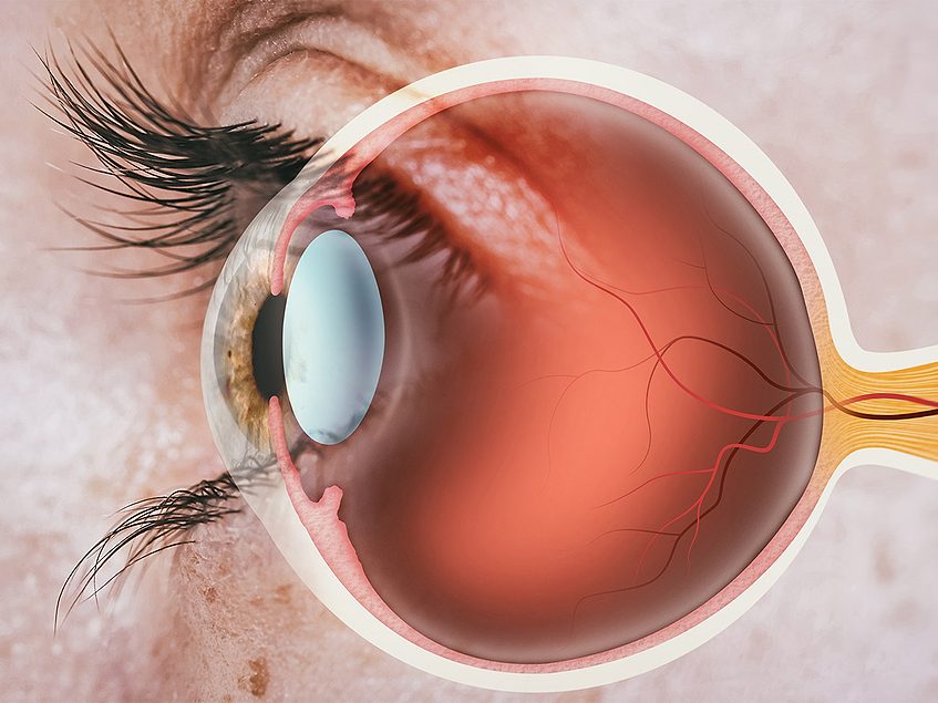 IND open for Ractigen’s RAG-1C in proliferative vitreoretinopathy