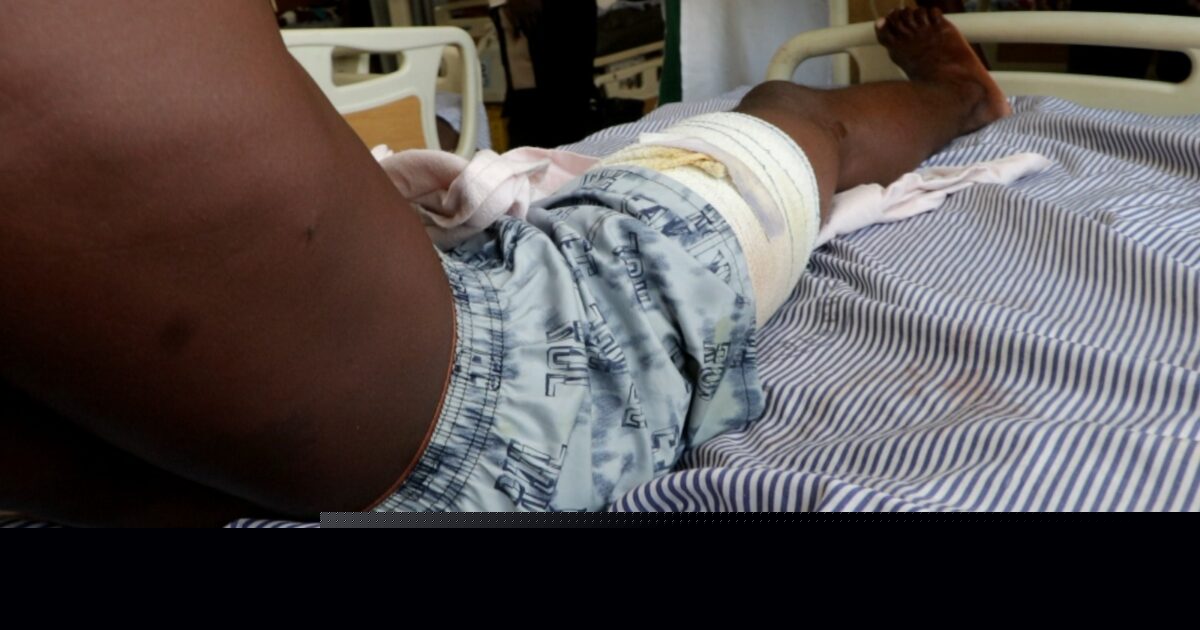 Stray bullet shatters bystander’s right leg in Wechiau clashes, MP demands swift justice