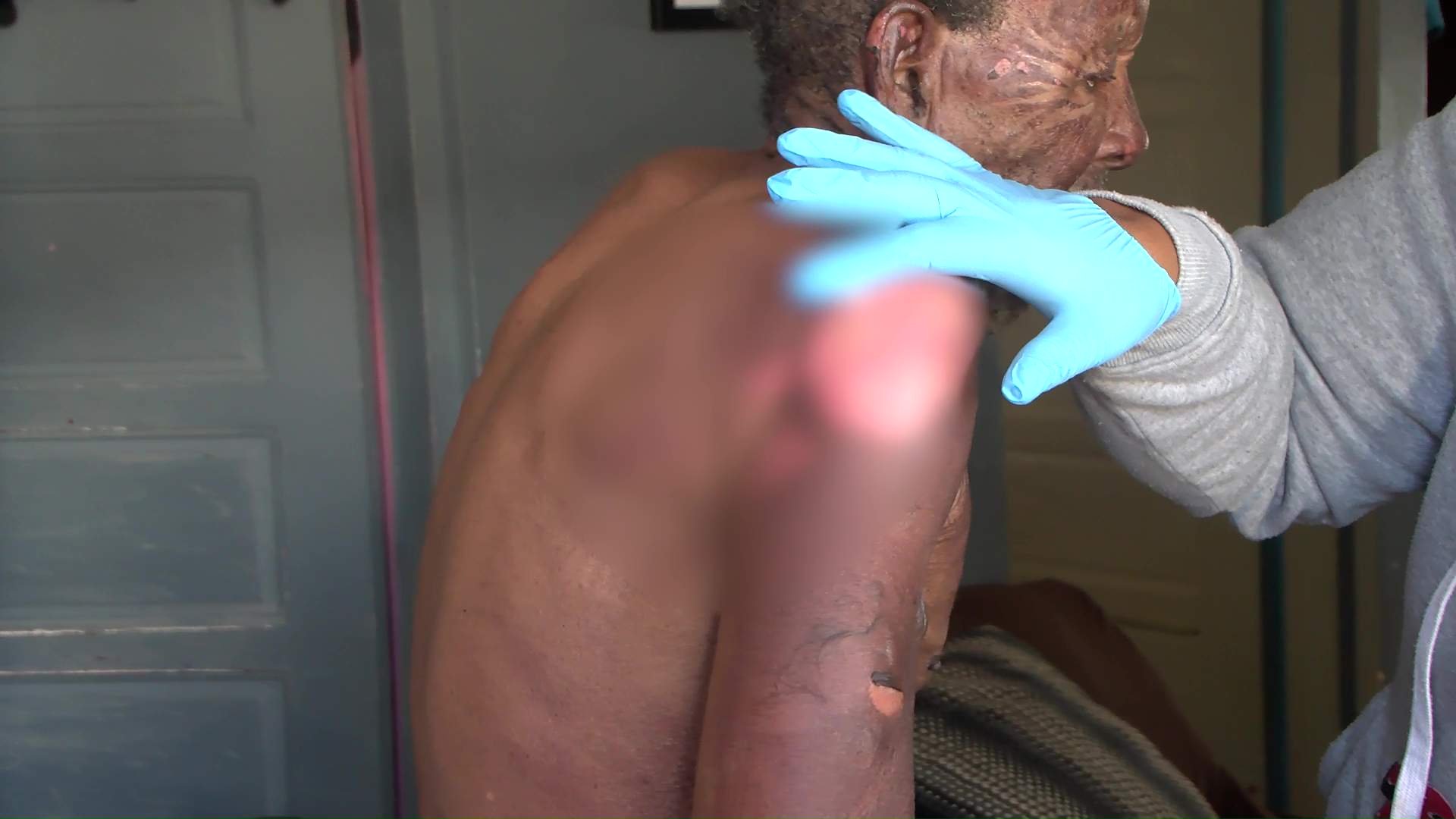 Incendio deja anciano hospitalizado en Belize