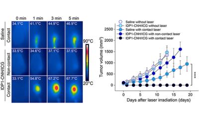 Photothermal therapy: Towards minimally invasive cancer treatment
