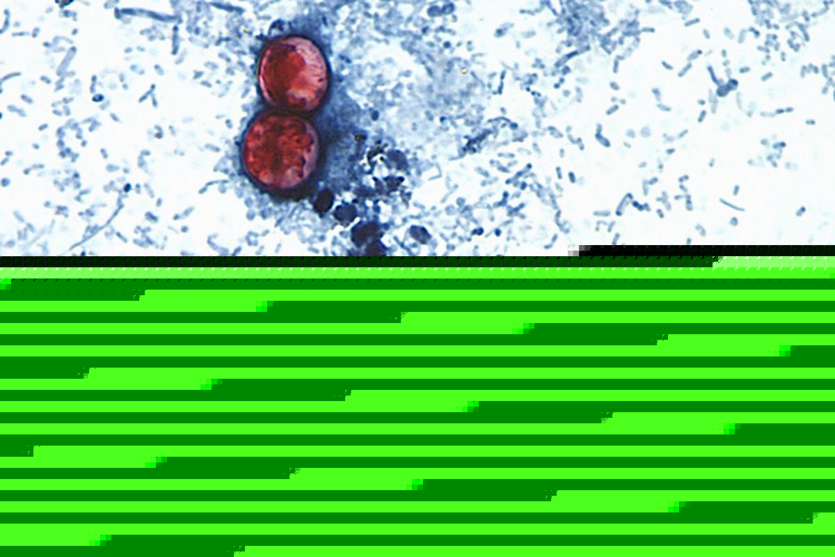 Michigan reports first 2 US deaths in outbreak of cyclospora