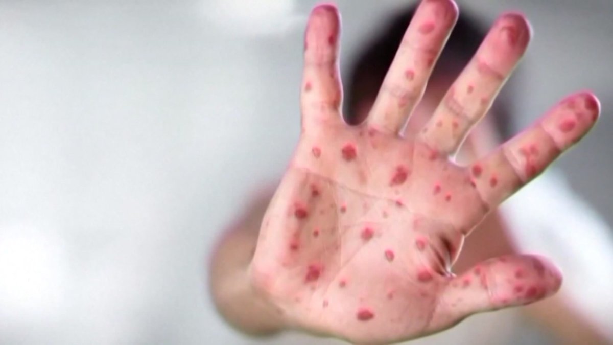 Pediatric measles case reported in Lehigh Valley, according to St. Luke's Health