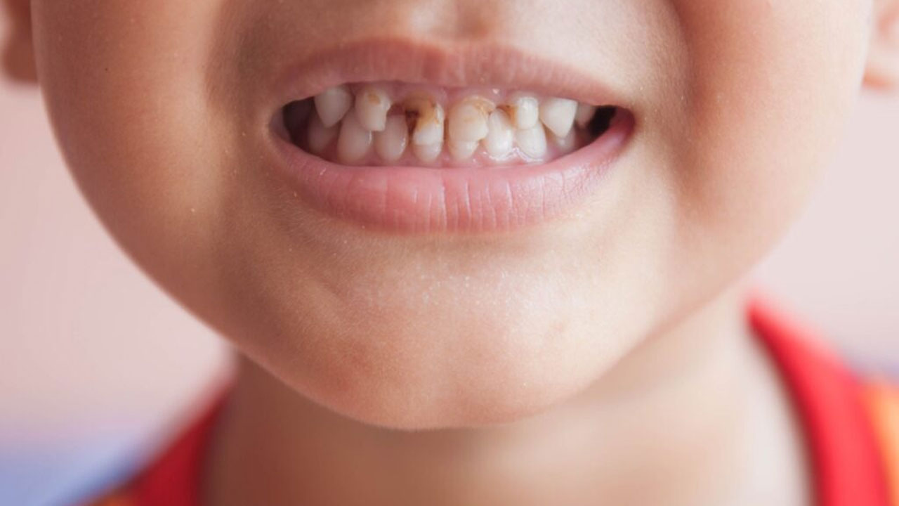 High tooth decay rates raise concerns