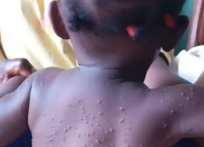 Mpox à Dschang : un cas confirmé, la vigilance de mise