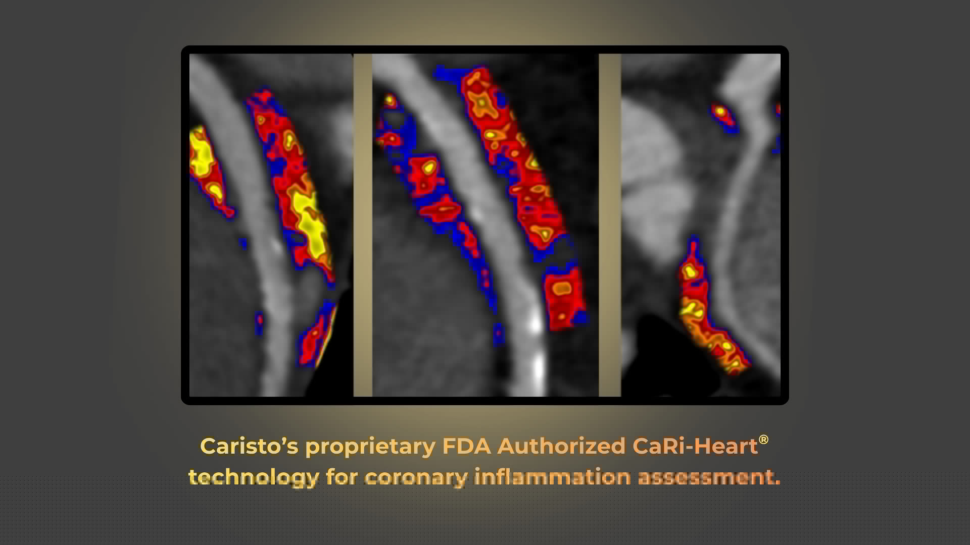 Caristo Diagnostics Receives FDA De Novo Authorization for CaRi-Heart AI Platform