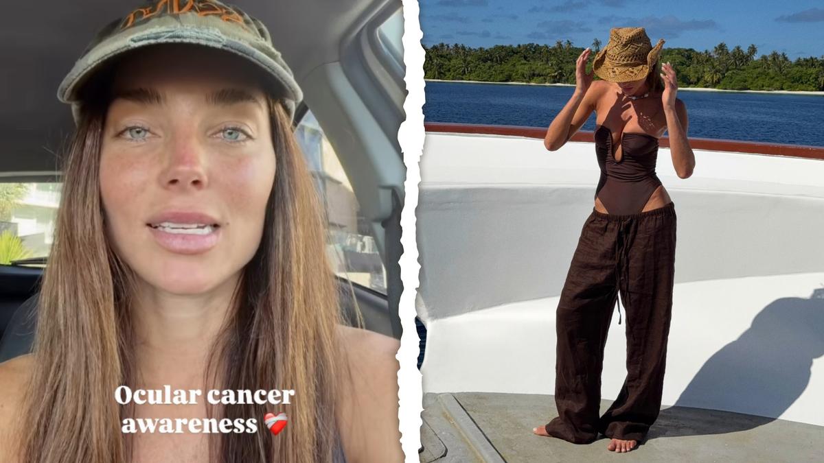 Aussie model shares stark public warning after being diagnosed with rare form of eye cancer