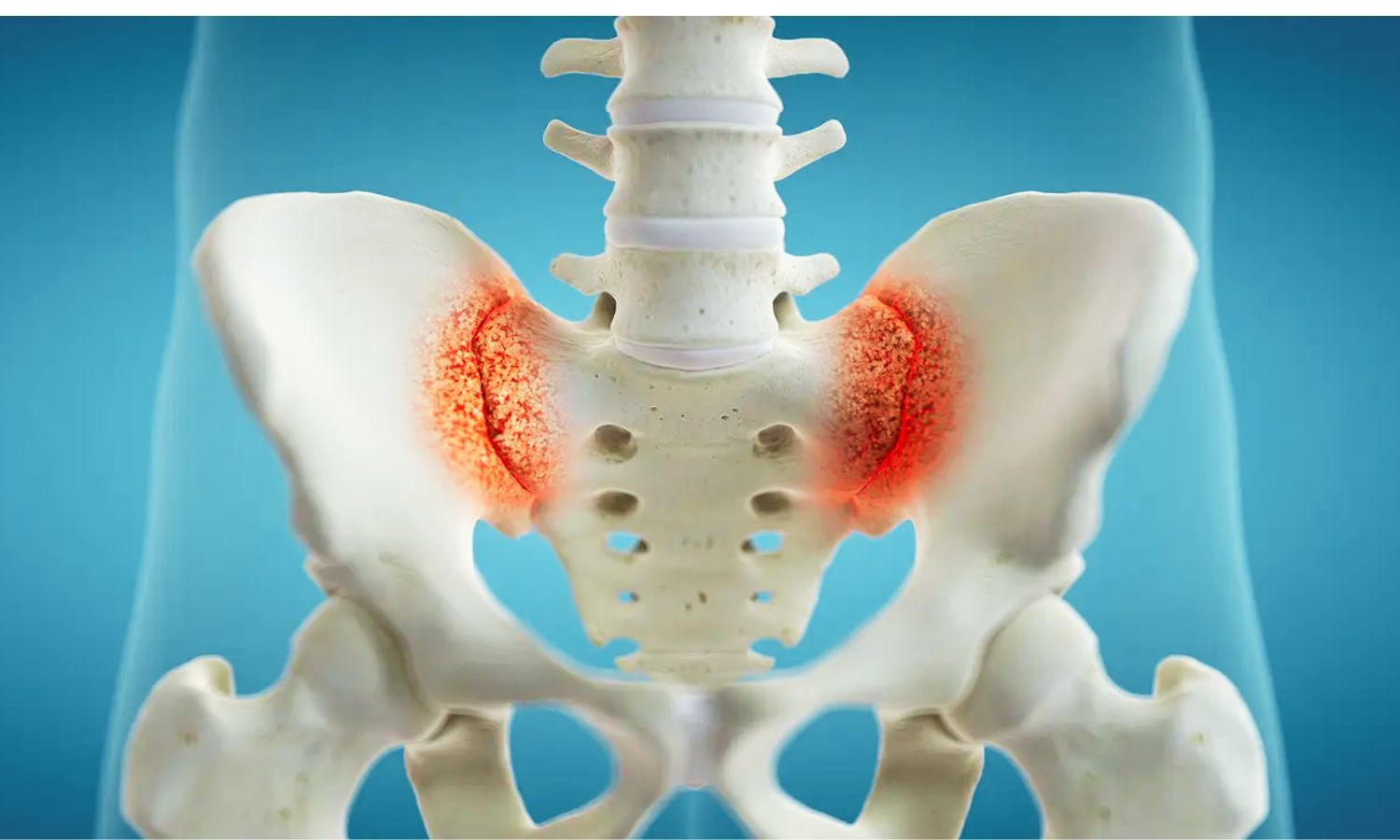 Sacroiliac Bone Marrow Edema May Be Less Specific for Axial Spondyloarthritis Than Previously Thought: Study