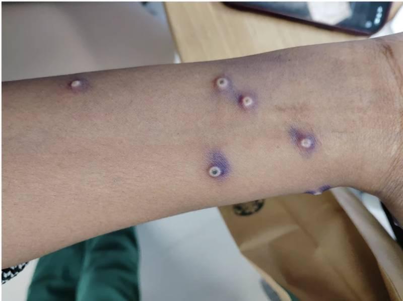 Detectan primer caso de mpox clado I en residente de San Diego