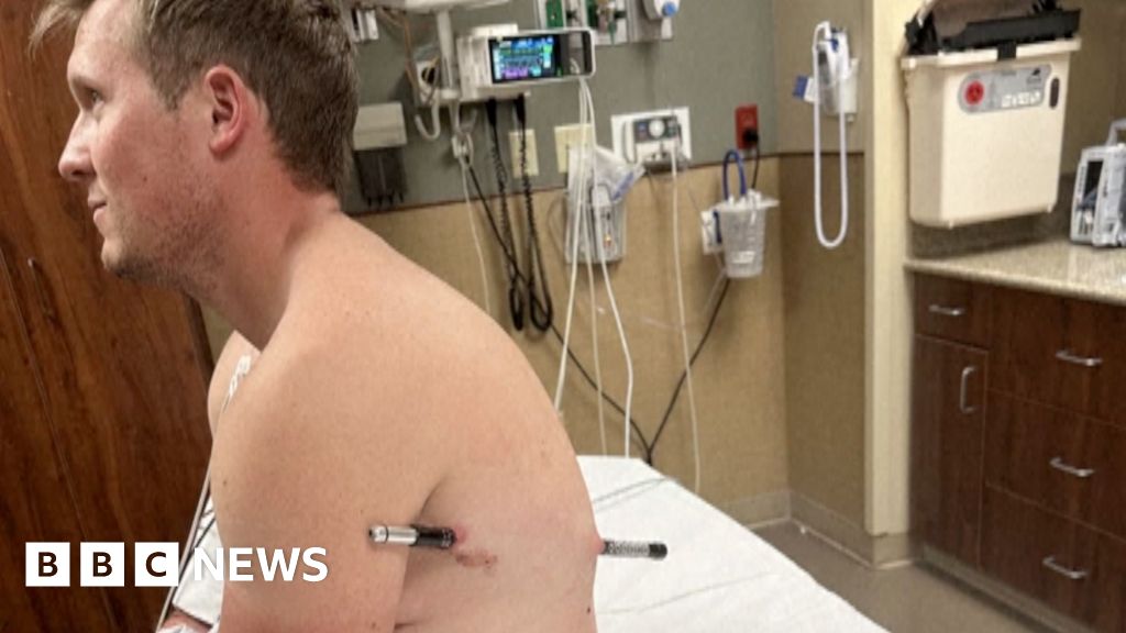 Man impaled by a hiking pole treks 10 miles down mountain