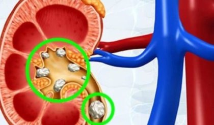 Shenjat që tregojnë praninë e gurëve në veshka