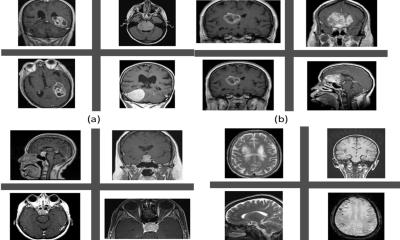 Two-step AI system detects brain tumors from MRI