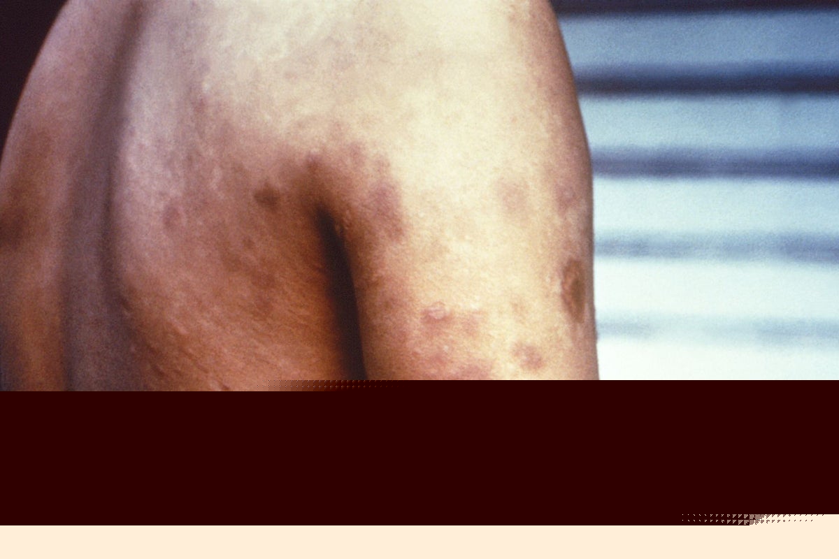 Leprosy cases are on the rise in Florida. Here’s how to reduce your risk
