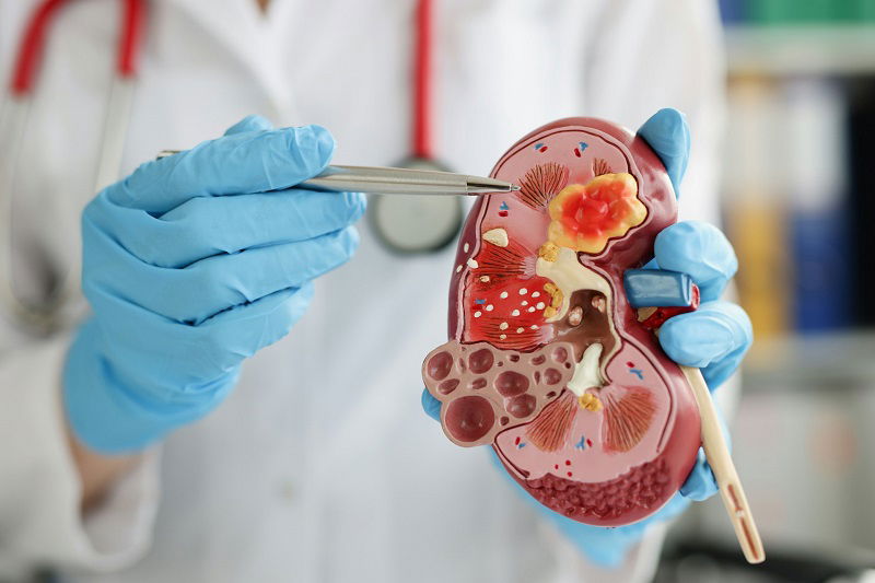 Gut microbiota transplants may boost kidney cancer treatment