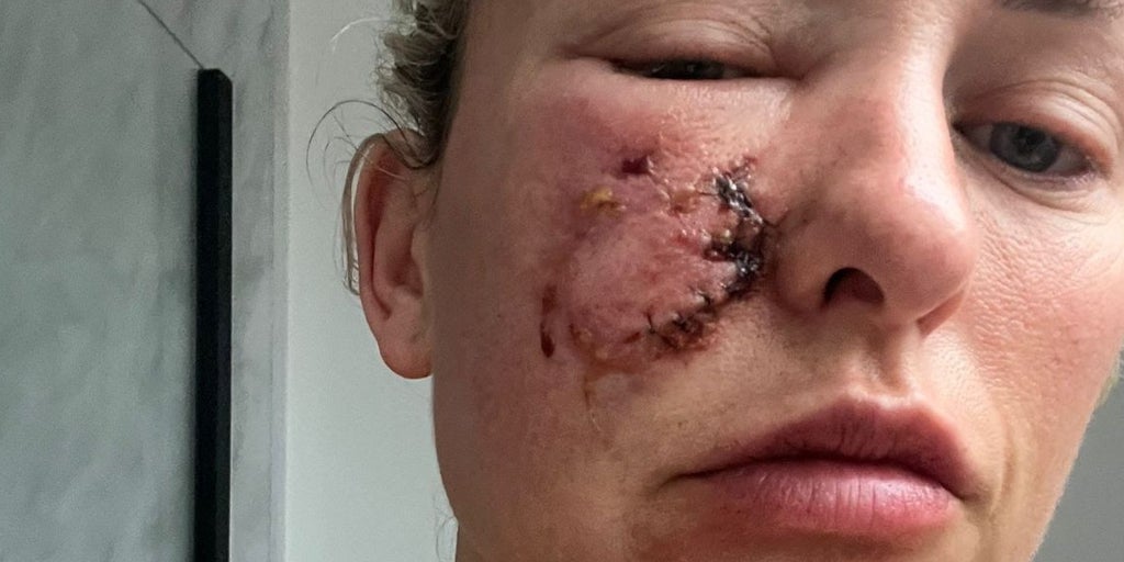 El nuevo láser facial que corrige rostros desfigurados, desde la mordedura de un perro a cicatrices imborrables