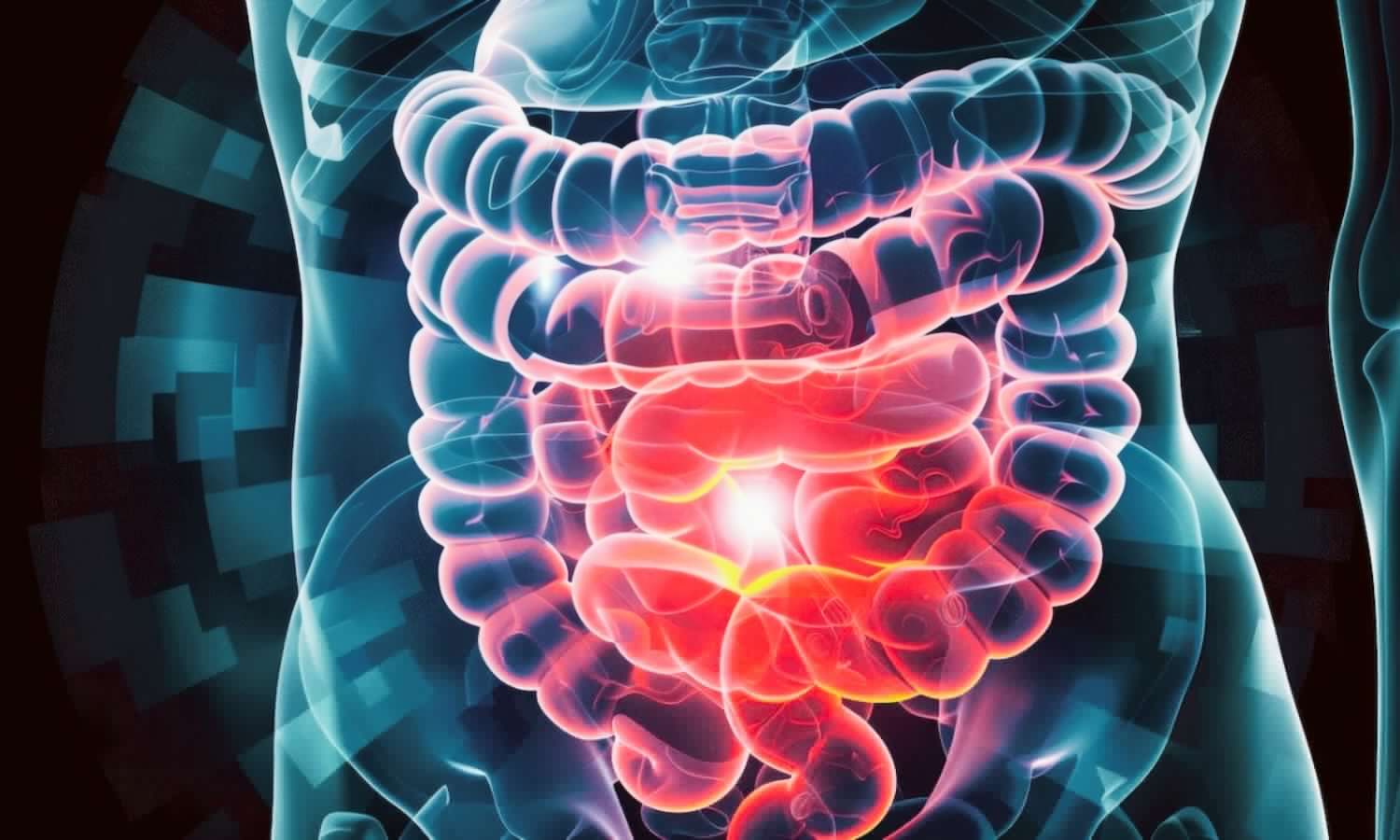 Delay in Colorectal Cancer Treatment Increases Risk of Metastasis: JAMA