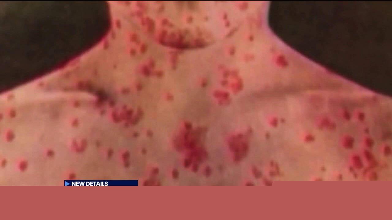 Measles cases reach highest level in decades as Florida prepares for school year