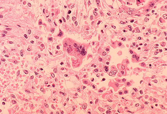 More than 50 people in quarantine due to possible measles exposure