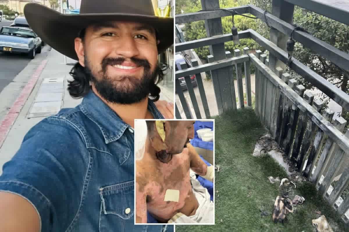 Ex-Navy rescue swimmer left with horrific burns after Amazon fire pit erupts in his face