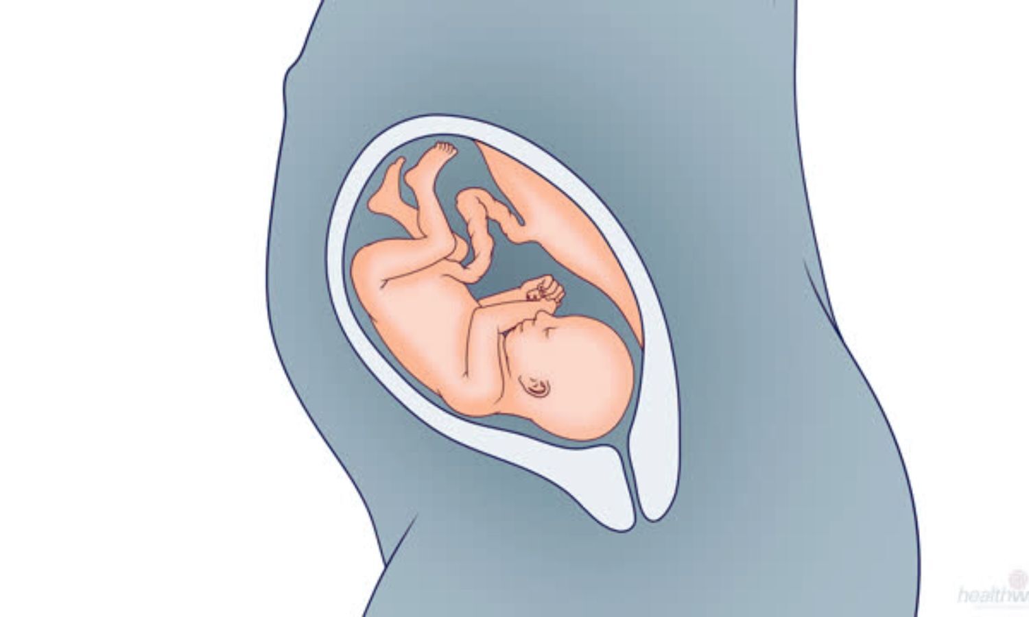 Lidocaine-Supplemented Epidural Analgesia Lowers Maternal Fever During Labor: New RCT Insights