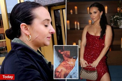 Ex-NJ GOP aide still carries visible scars after she paid fetish artist to carve her up as part of Trump attack hoax