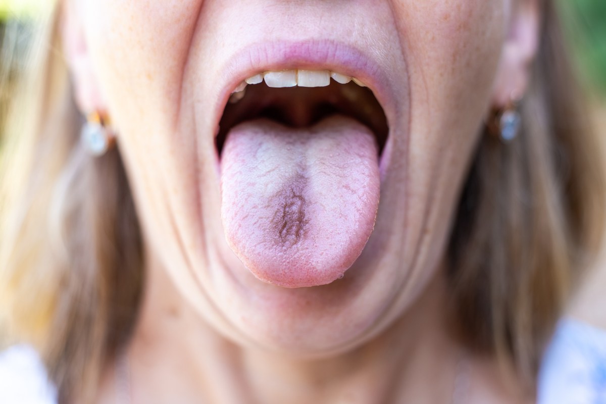 I'm a Hygienist—What Your Tongue Reveals About Your Health
