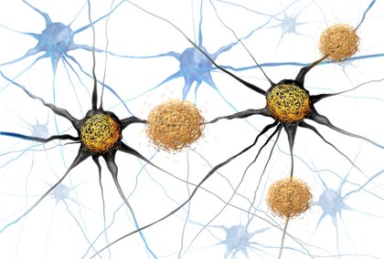 Study: Specific Sleeping Pill Blocks Tau-Mediated Neurodegeneration in Mice