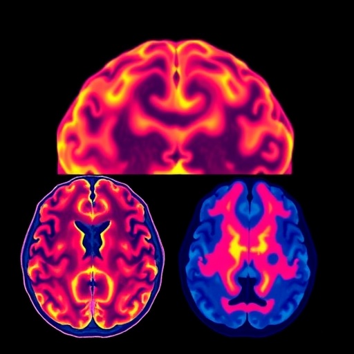 New Imaging Model May Improve Tracking of Brain Changes in Neurodegenerative Diseases