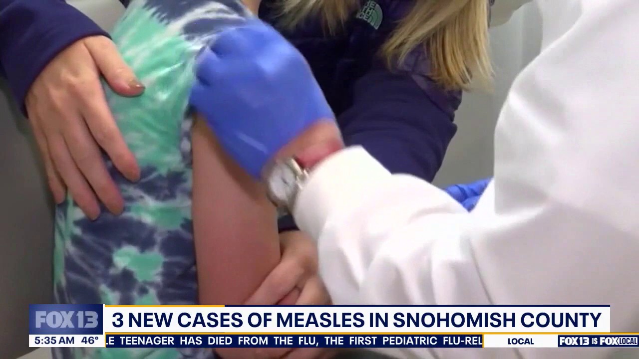 3 children in Snohomish County, WA test positive for measles