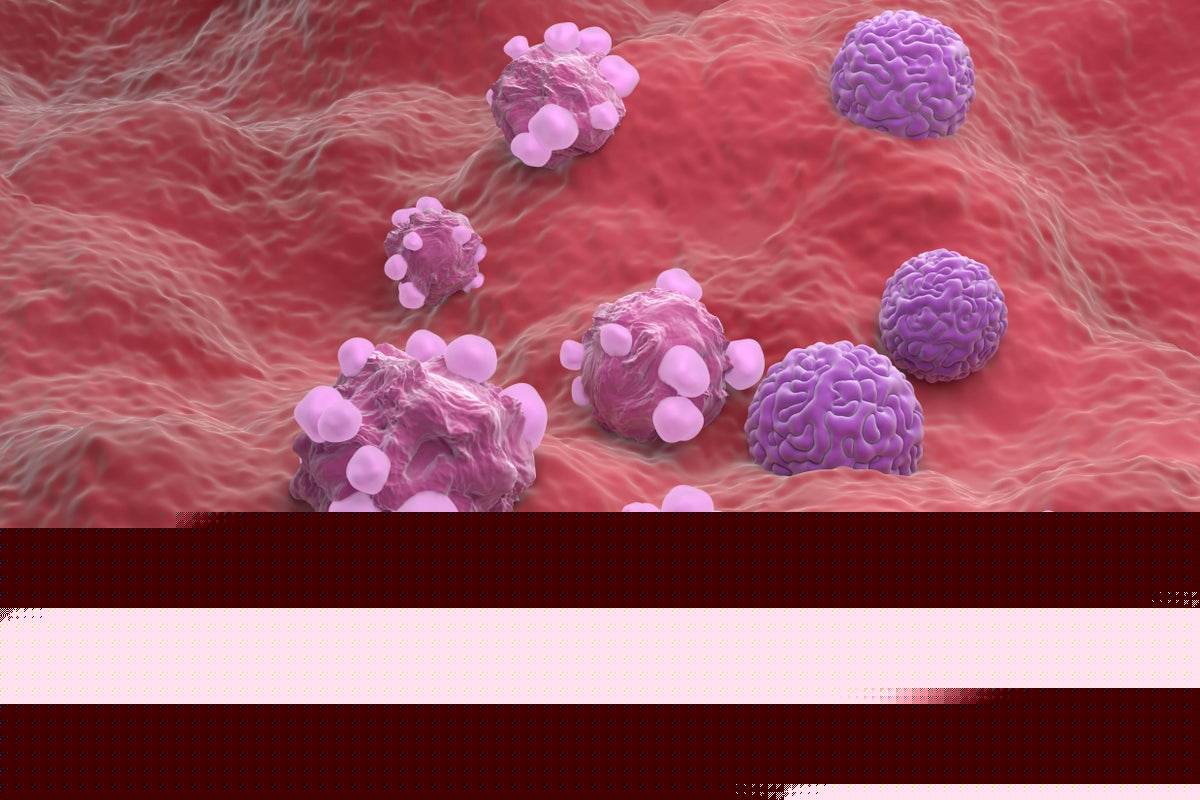 New test cuts chance of late-stage ovarian cancer