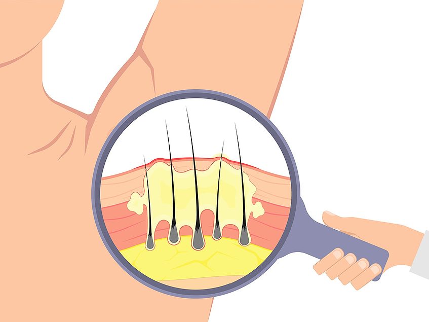 Spyre initiates SPY-772 program in hidradenitis suppurativa