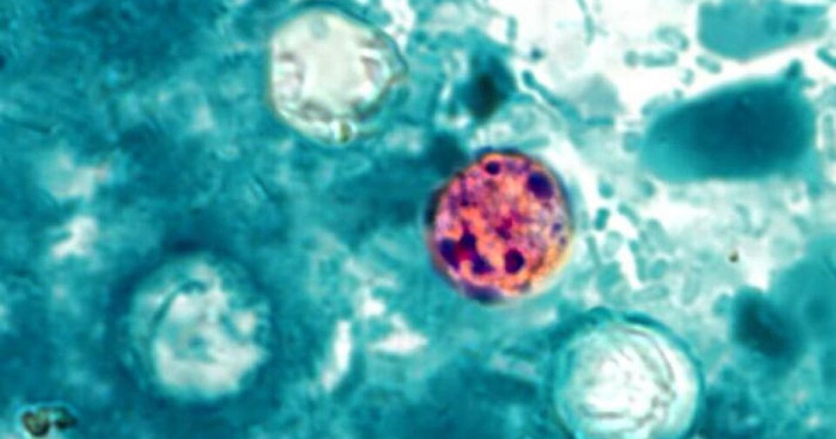 Cyclospora Outbreak Map 2026: States Reporting Cases Across the US