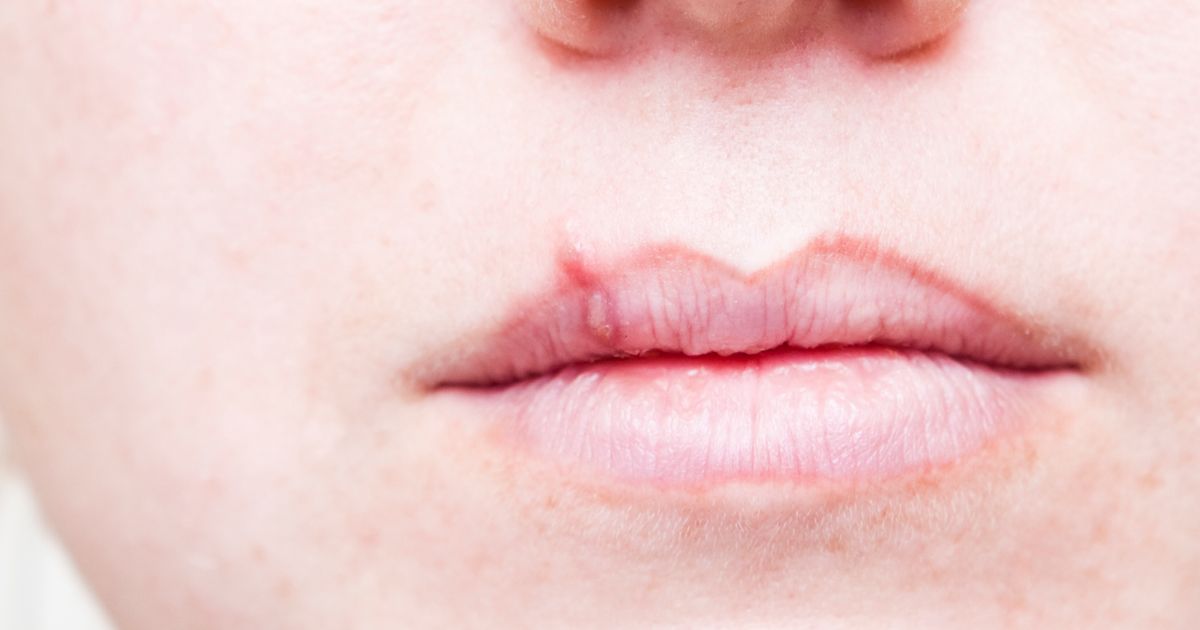 Get rid of cold sores 'overnight' as doctor shares 'secret' method to stop them
