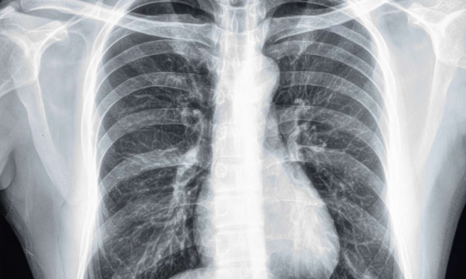 Incidental Coronary Calcium on Routine Chest CT May Predict Cardiovascular Risk: Study