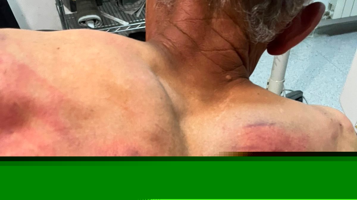 (UZNEMIRUJUĆE FOTOGRAFIJE) ODVELI GA U ŠUMU, VEZALI ZA DRVO I BRUTALNO TUKLI CREVOM ZA VODU! Jezivo nasilje tzv. kosovske policije nad Srbinom: Tražili da prizna da je počinio zločin