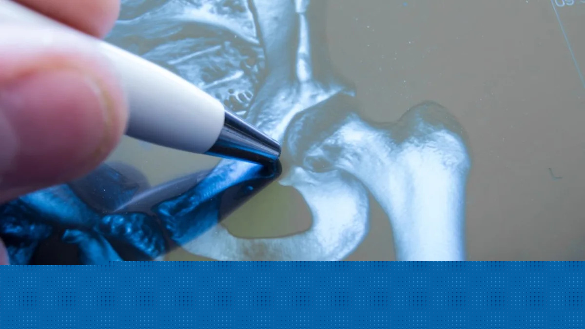 Smith & Nephew tumbles after cutting sales outlook on weak US hips and knees - UPDATE