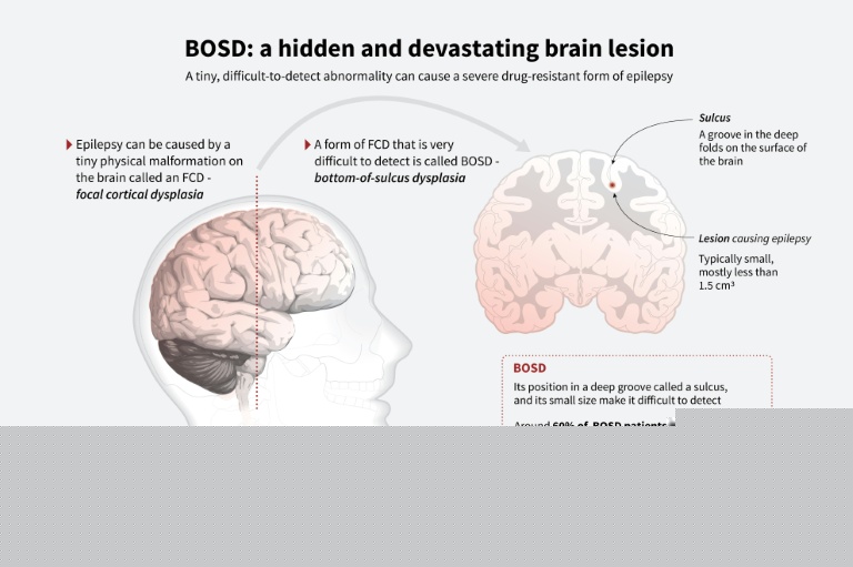 AI tool helps researchers treat child epilepsy
