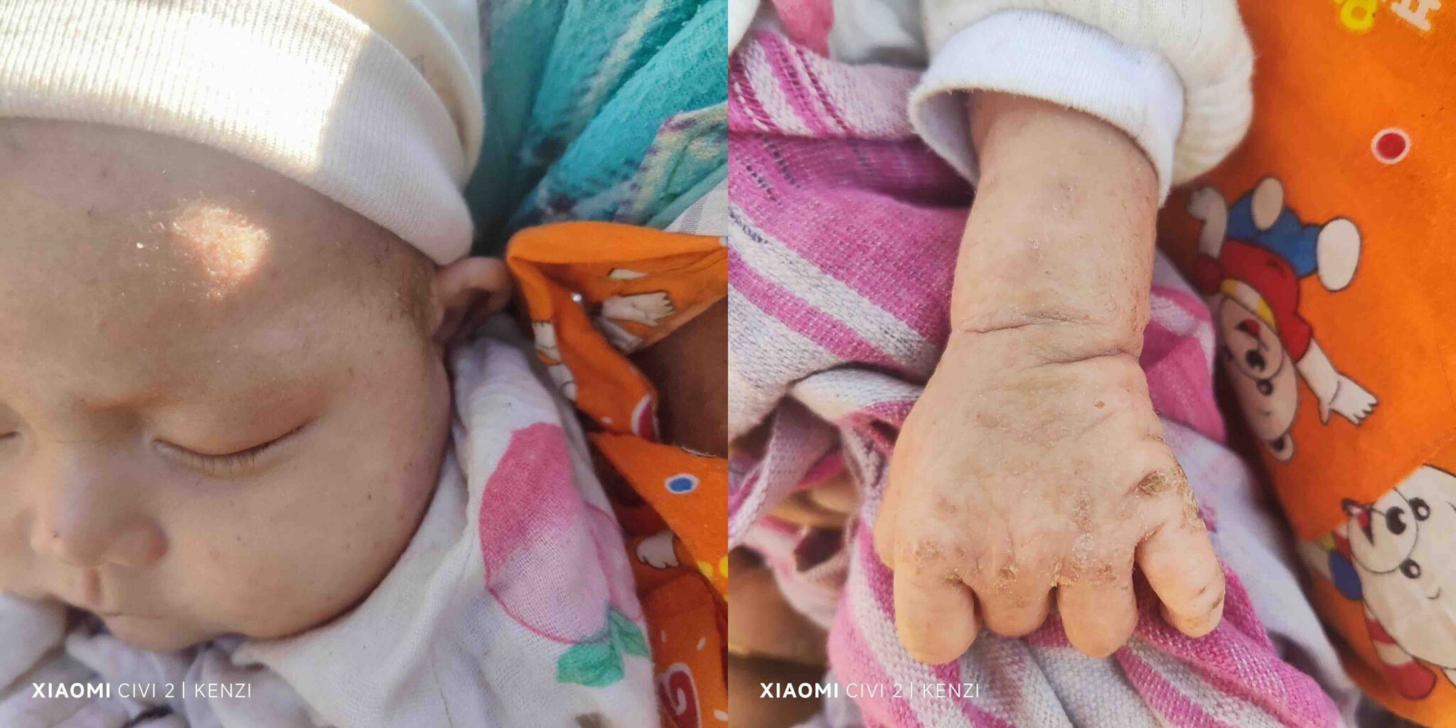 War-displaced civilians suffer major outbreak of skin disease in Myanmar’s Magway Region