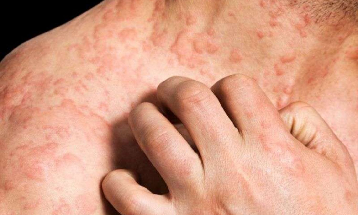 NB-UVB Phototherapy Effective Alternative to Cyclosporine for Refractory CSU: Study