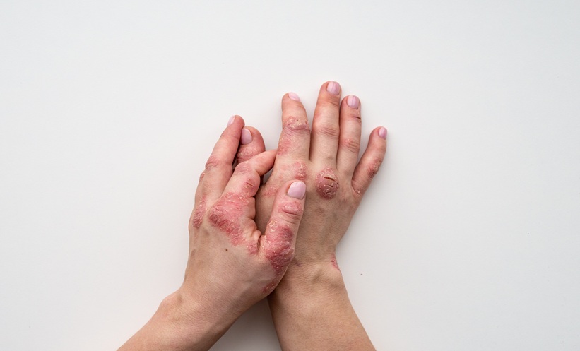 Optical Coherence Therapy Reveals Subclinical Benefits of Risankizumab in Psoriasis