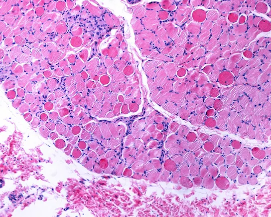 Capricor Duchenne cell therapy voted down by FDA panel