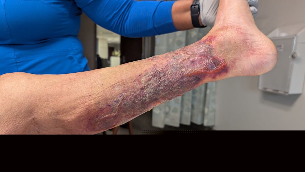 First flesh-eating bacteria death of 2026 recorded in this state