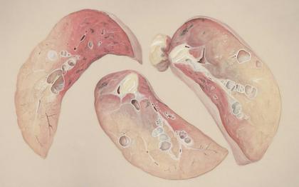 Not all ALK fusions act the same: Variants influence treatment success in lung cancer