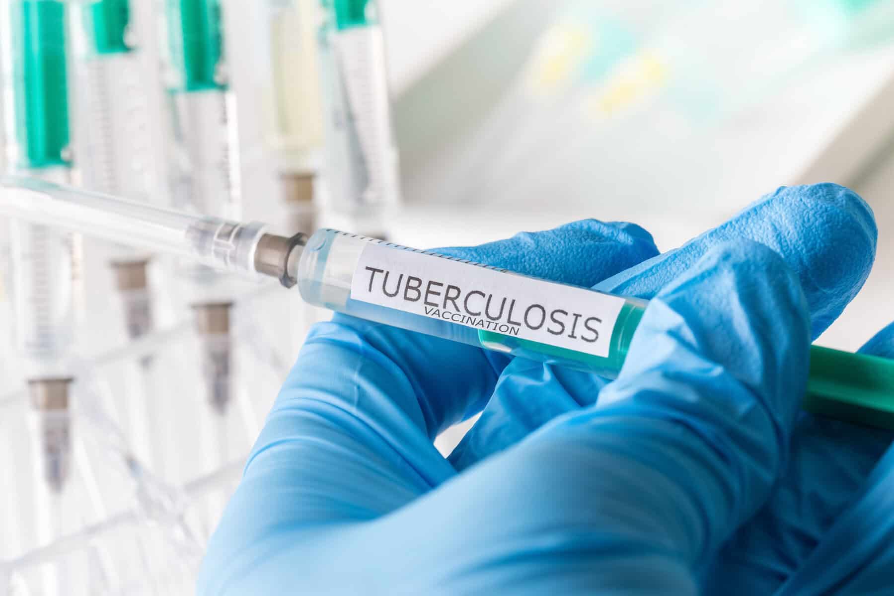 Good news in SA’s fight against TB