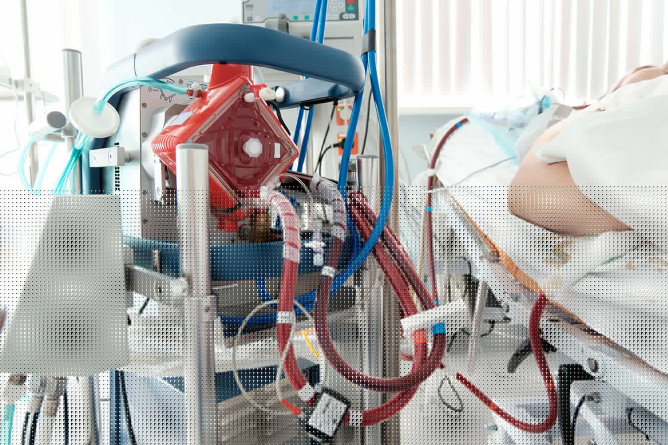 Micro-Axial Flow Pump Matches VA-ECMO for High-Risk PCI: Study