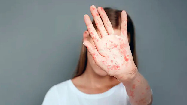 WHO strips Uzbekistan of measles-free status due to outbreaks