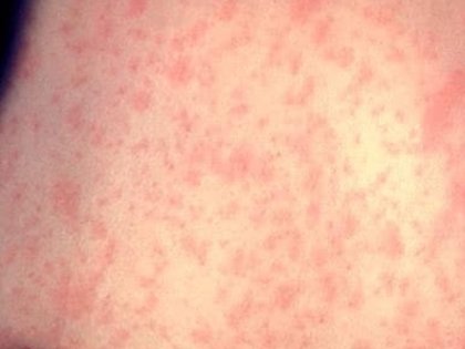 Oregon warns of possible measles exposure at Kaiser Permanente’s Clackamas hospital