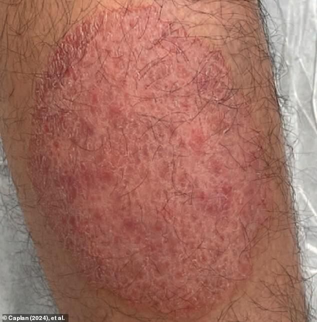First-ever case of ringworm as an STD reported, doctors warn it's highly contagious